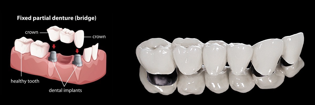 Marietta Dental Crowns